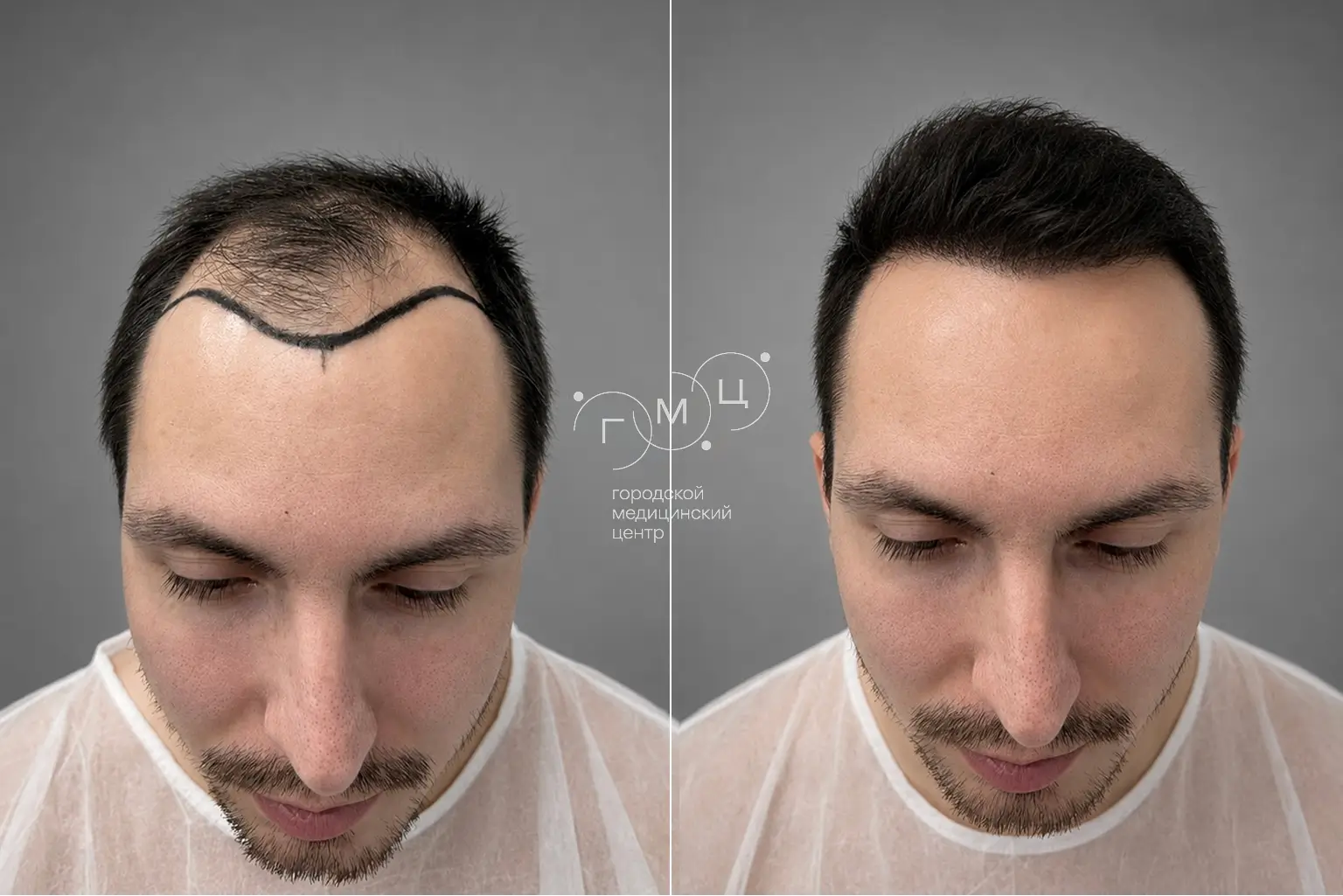 Scalp hair transplant: photo before and 12 months later, 3000 grafts, FUE method