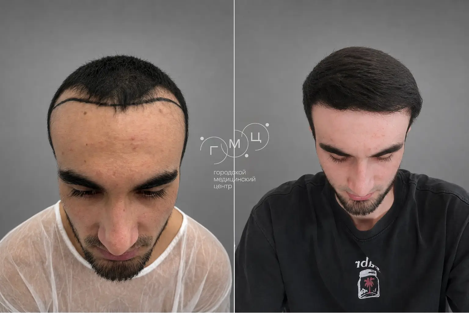 Scalp hair transplant: photo before and 12 months later, 2700 grafts, FUE method