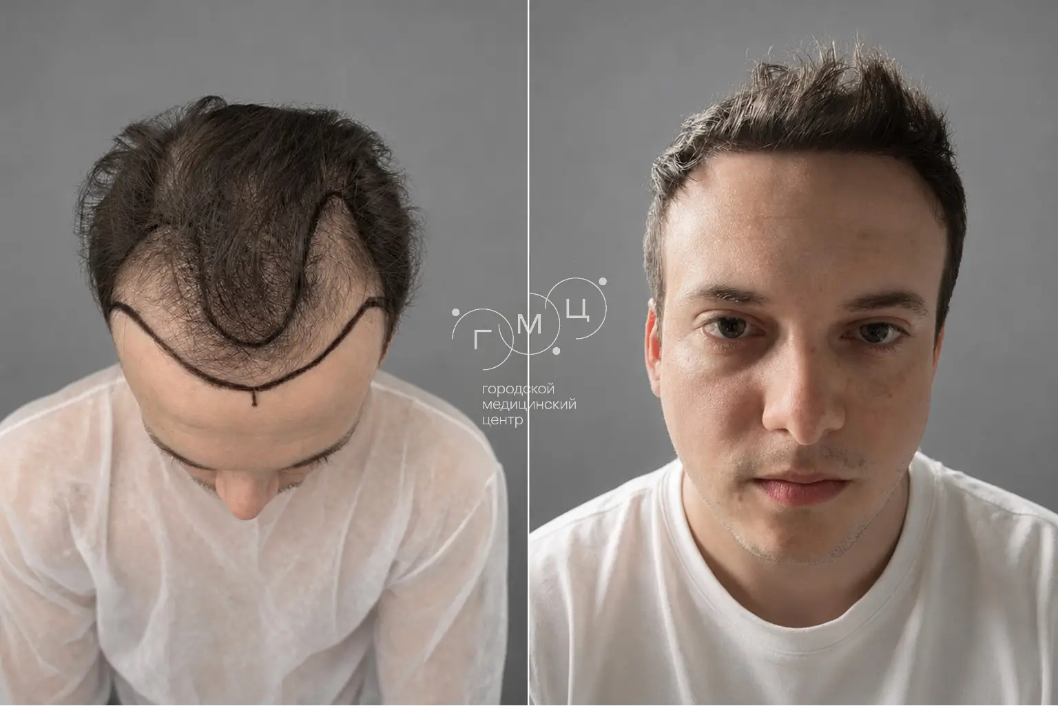 Scalp hair transplant: photo before and 12 months later, 3800 grafts, FUE method
