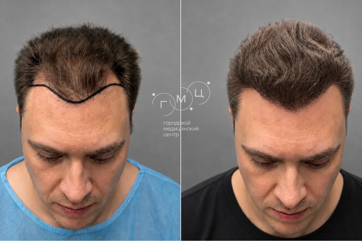 Scalp hair transplant: photo before and 12 months later, 3300 grafts, FUE method
