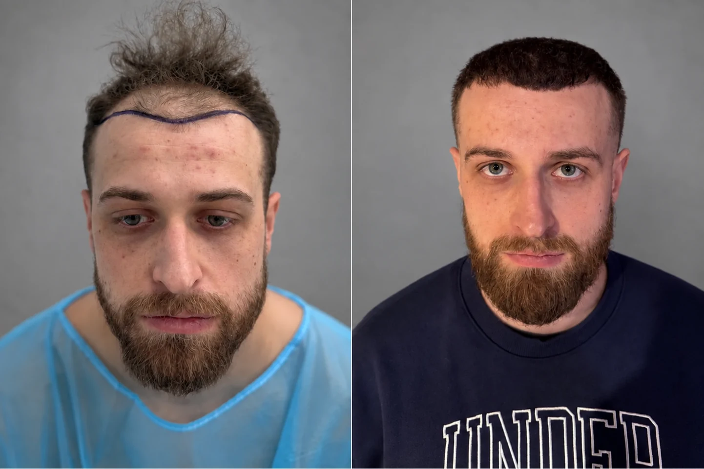 Przeszczep włosów na głowie: zdjęcie przed i 12 miesięcy później, 2800 graftów, metoda FUE