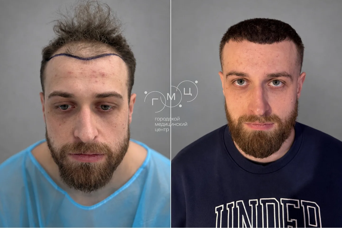 Scalp hair transplant: photo before and 12 months later, 2800 grafts, FUE method