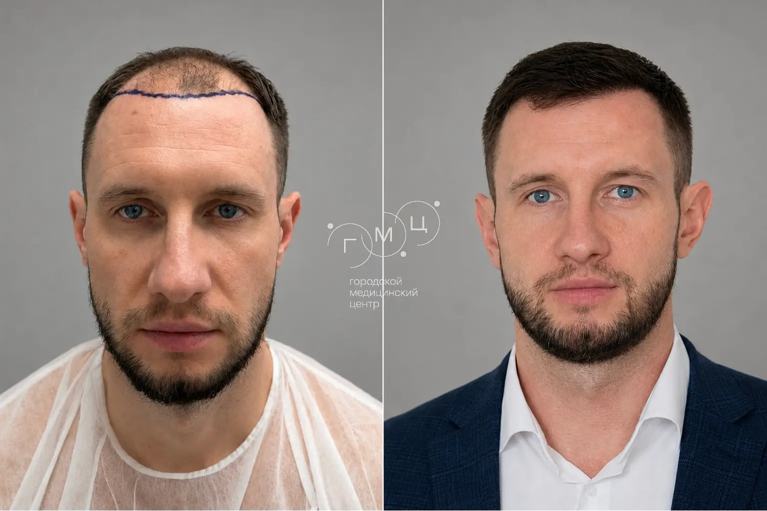Scalp hair transplant: photo before and 12 months later, 2900 grafts, FUE method