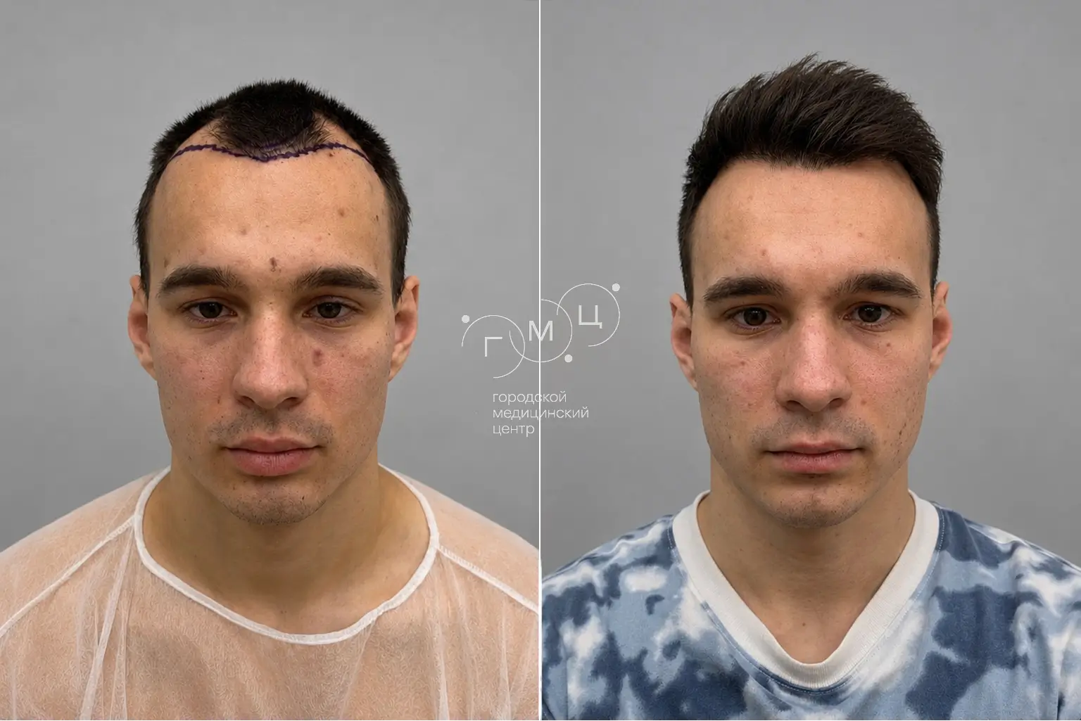 Scalp hair transplant: photo before and 12 months later, 2500 grafts, FUE method