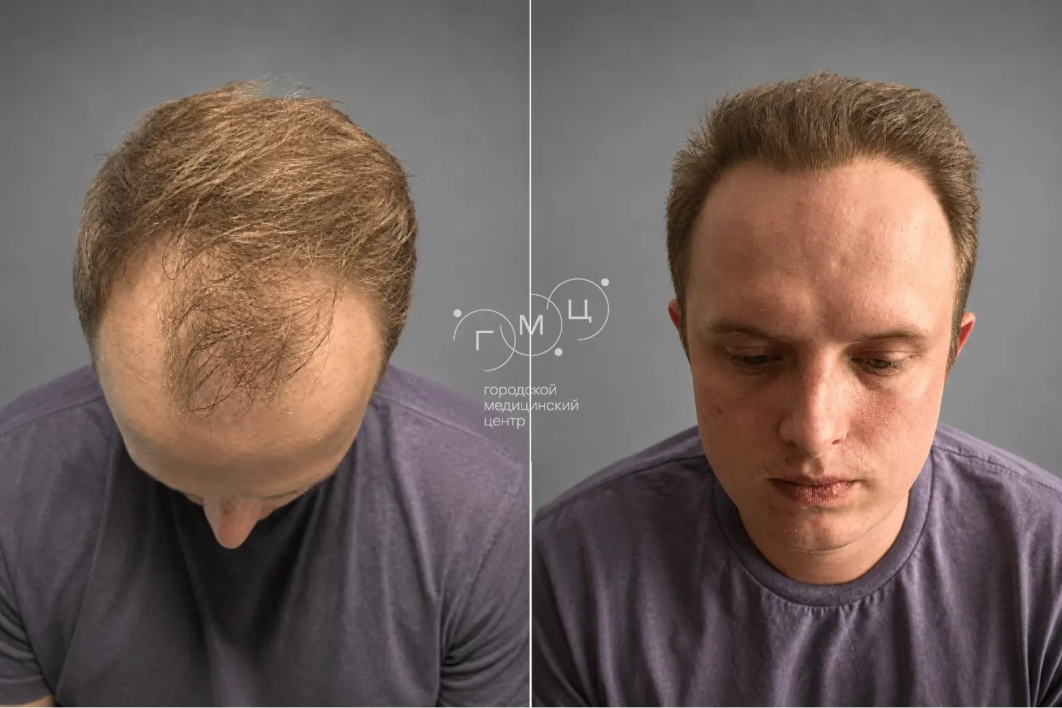 Scalp hair transplant: photo before and 12 months later, 3500 grafts, FUE method