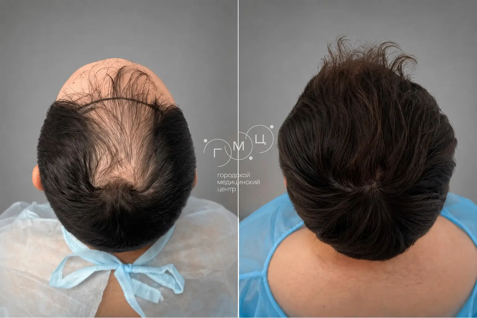 Scalp hair transplant: photo before and 12 months later, 3800 grafts, FUE method
