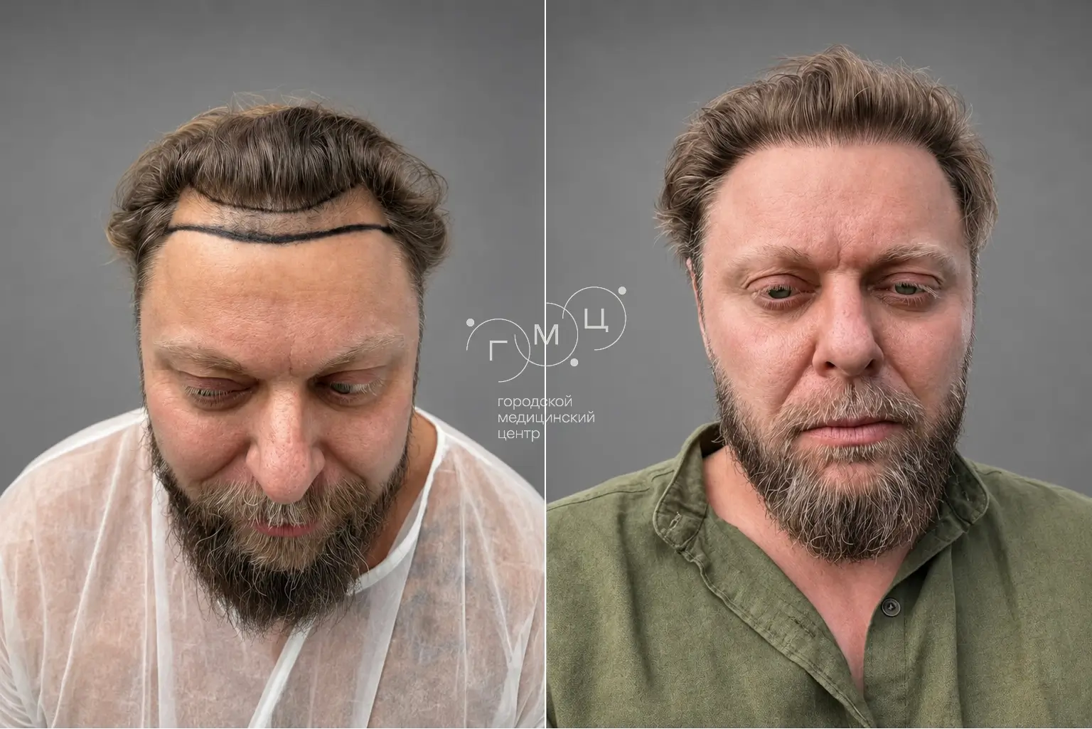 Scalp hair transplant: photo before and 12 months later, 2900 grafts, FUE method