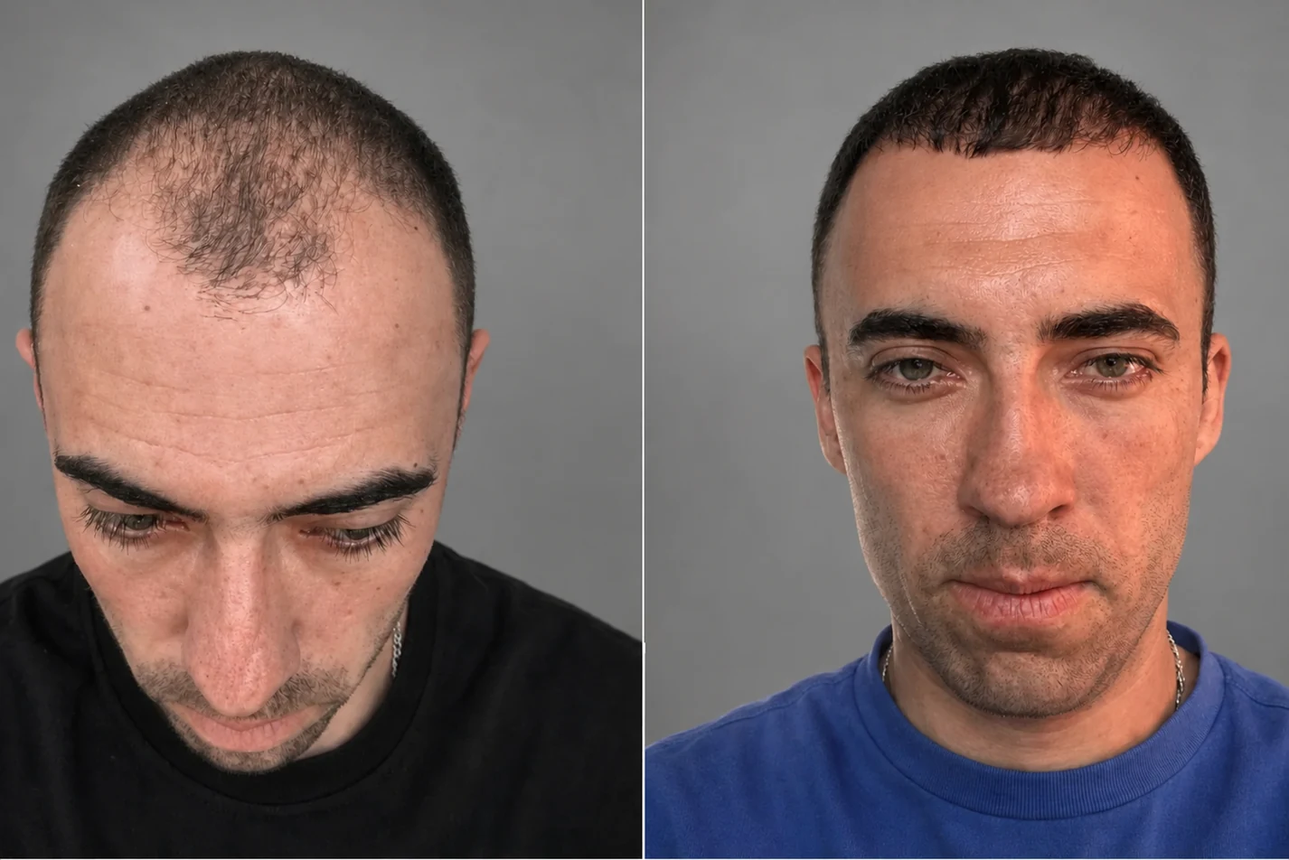 Przeszczep włosów na głowie: zdjęcie przed i 12 miesięcy później, 3600 graftów, metoda FUE