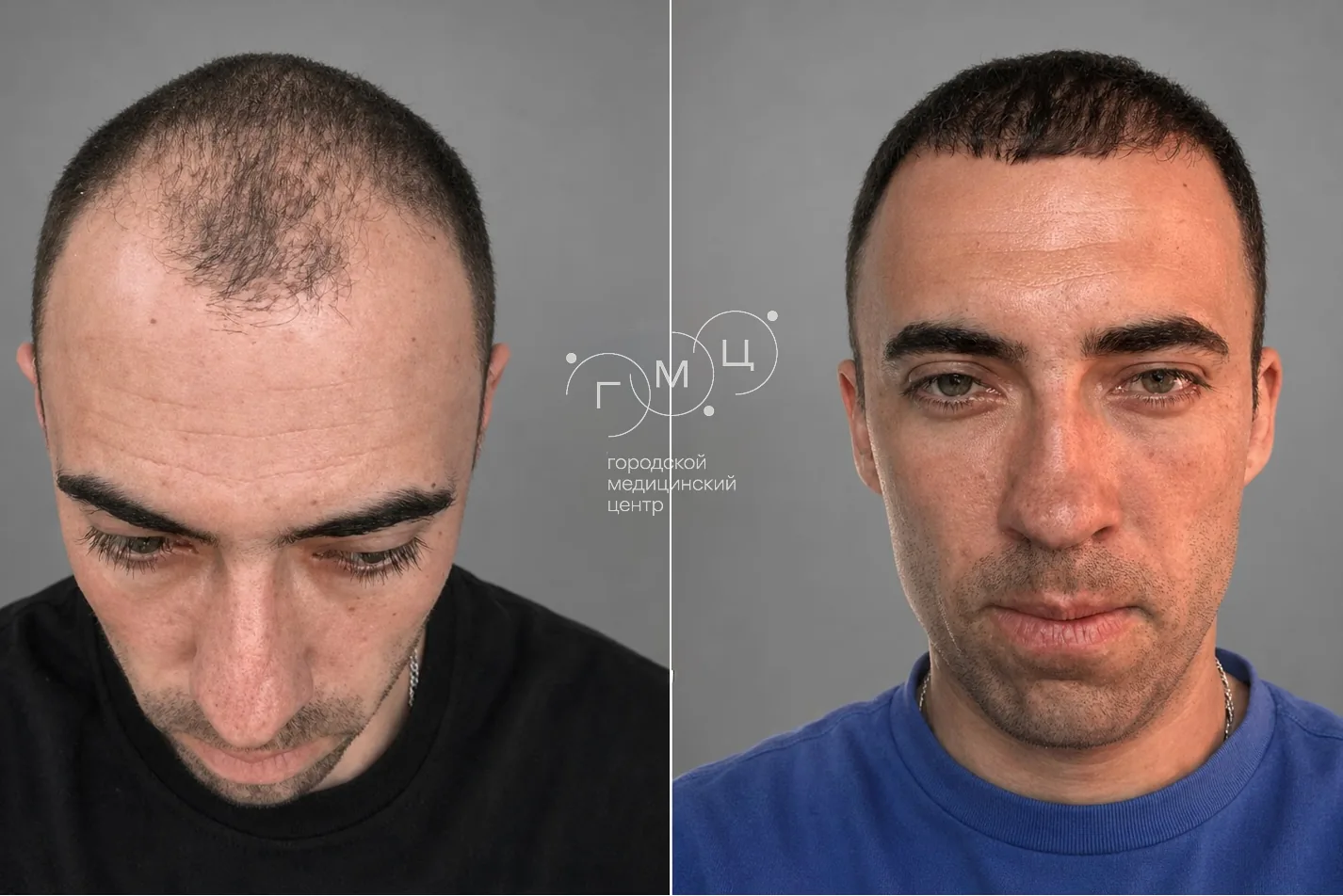 Scalp hair transplant: photo before and 12 months later, 3600 grafts, FUE method