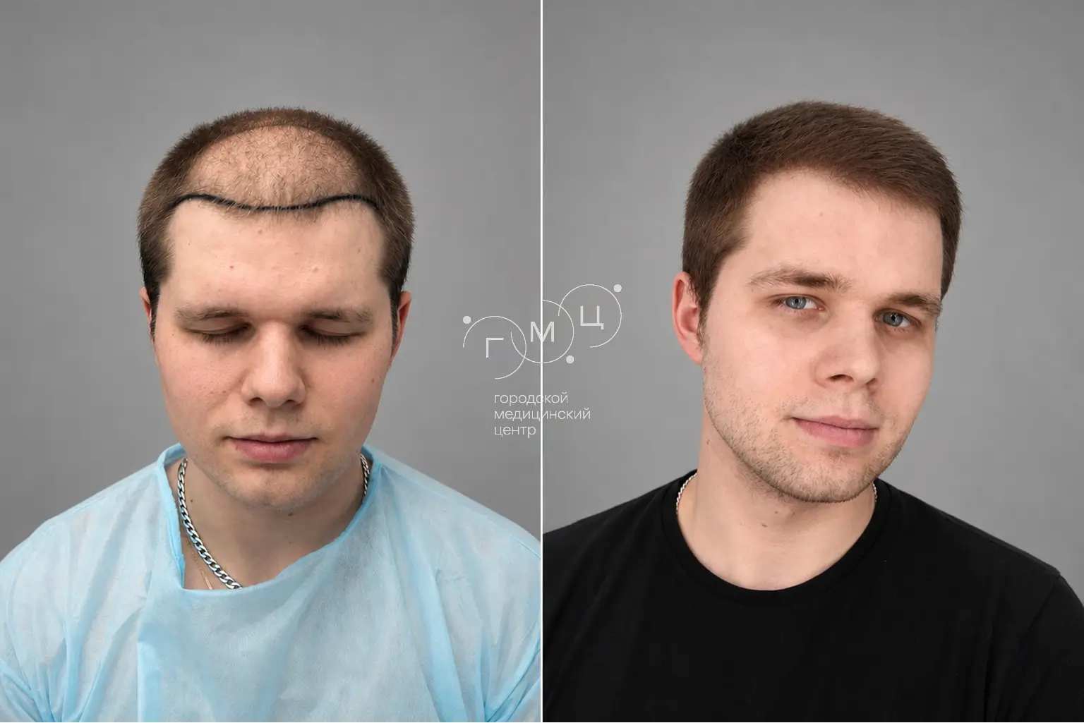 Scalp hair transplant: photo before and 12 months later, 2600 grafts, FUE method