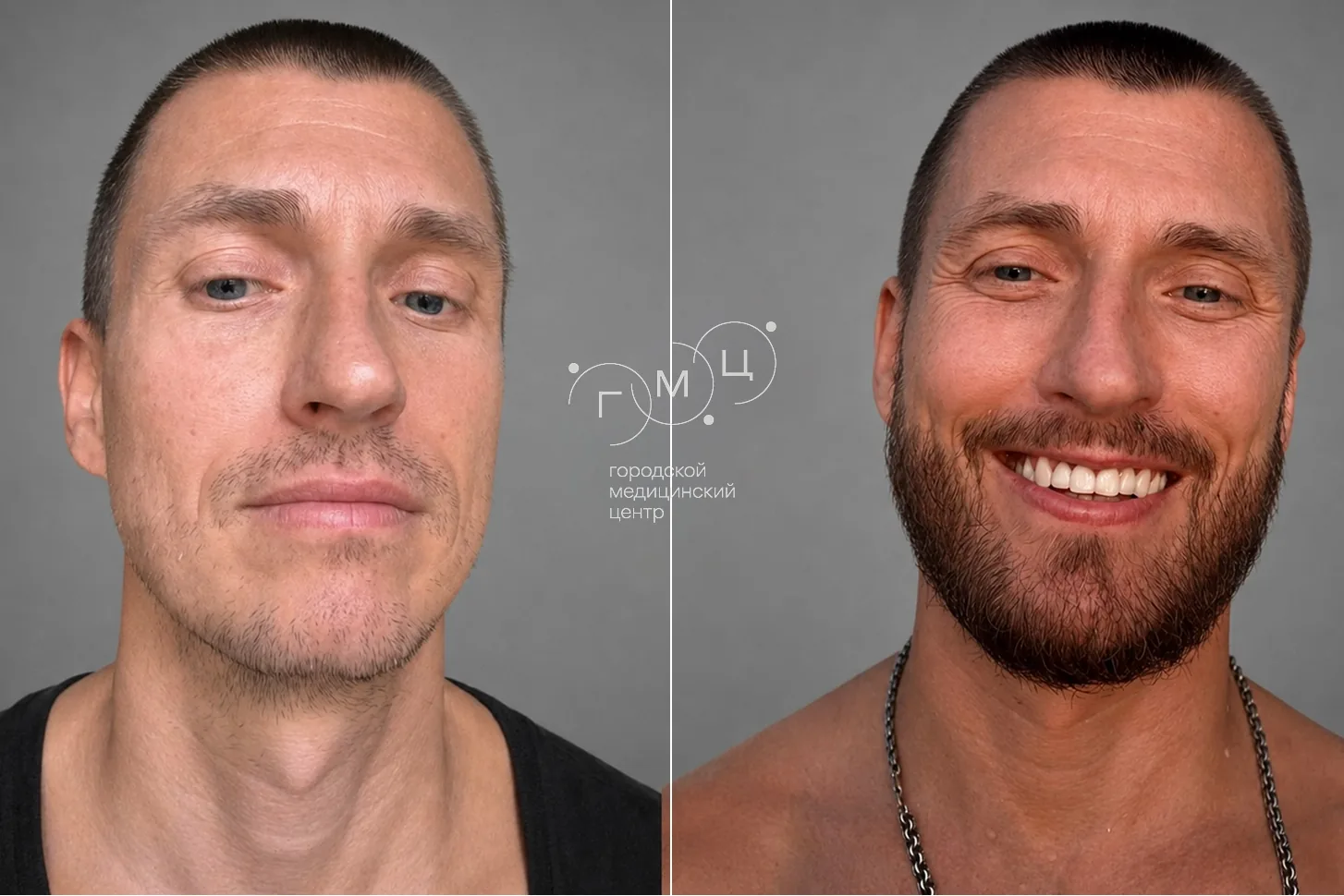 Beard transplant: photo before and 12 months later, 2700 grafts, FUE method