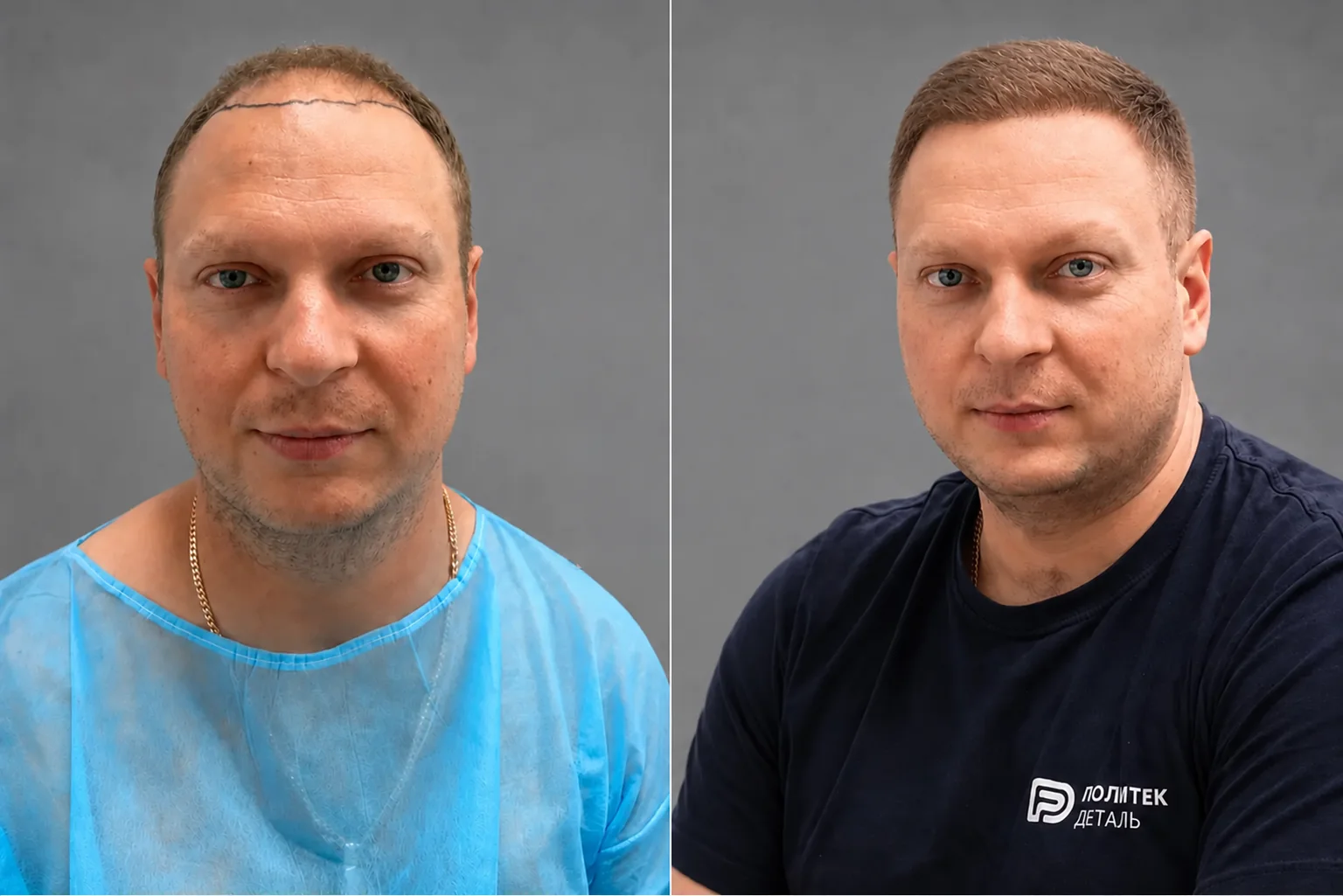 Przeszczep włosów na głowie: zdjęcie przed i 12 miesięcy później, 3300 graftów, metoda FUE