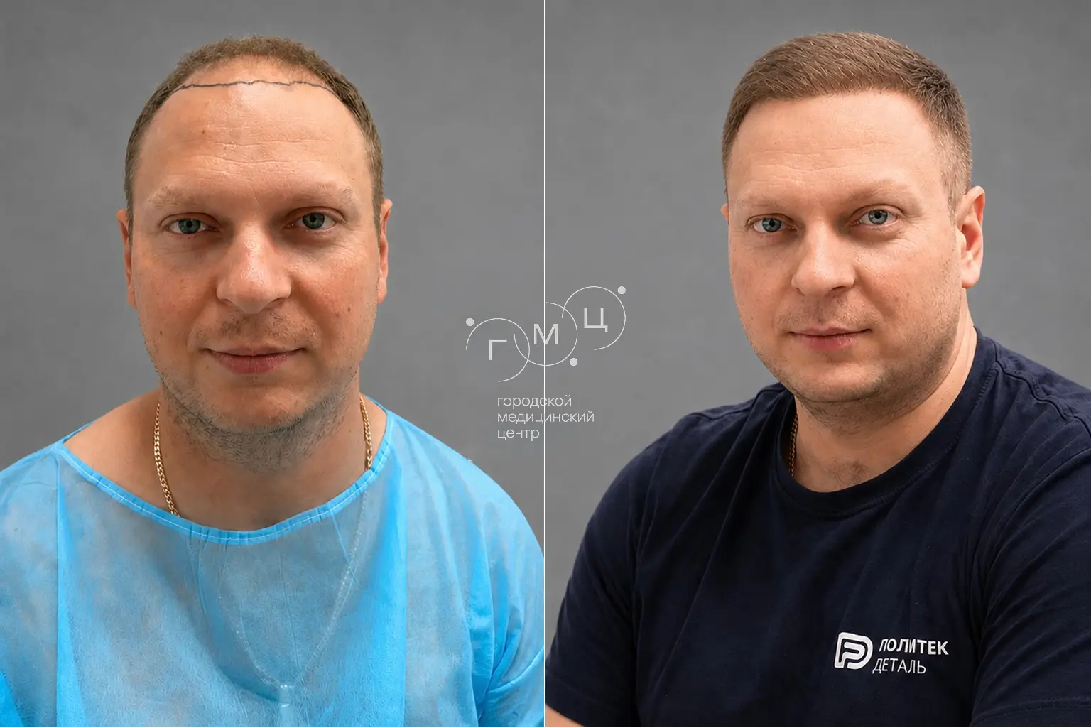 Scalp hair transplant: photo before and 12 months later, 3300 grafts, FUE method