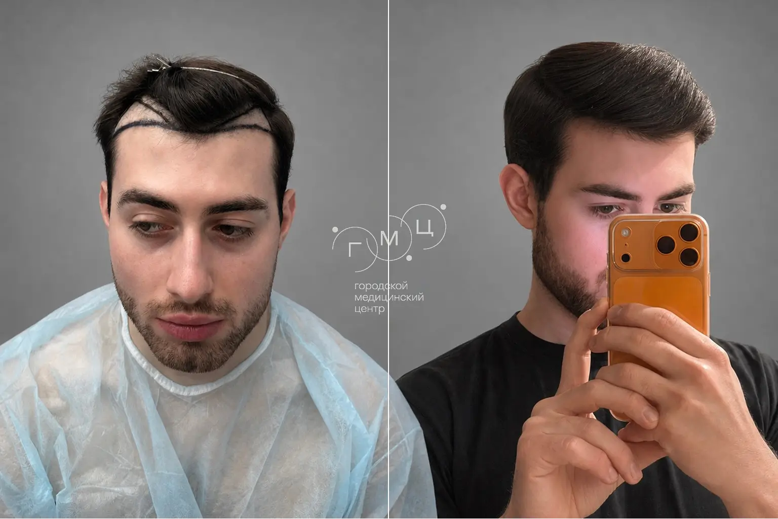Scalp hair transplant: photo before and 12 months later, 2600 grafts, FUE method