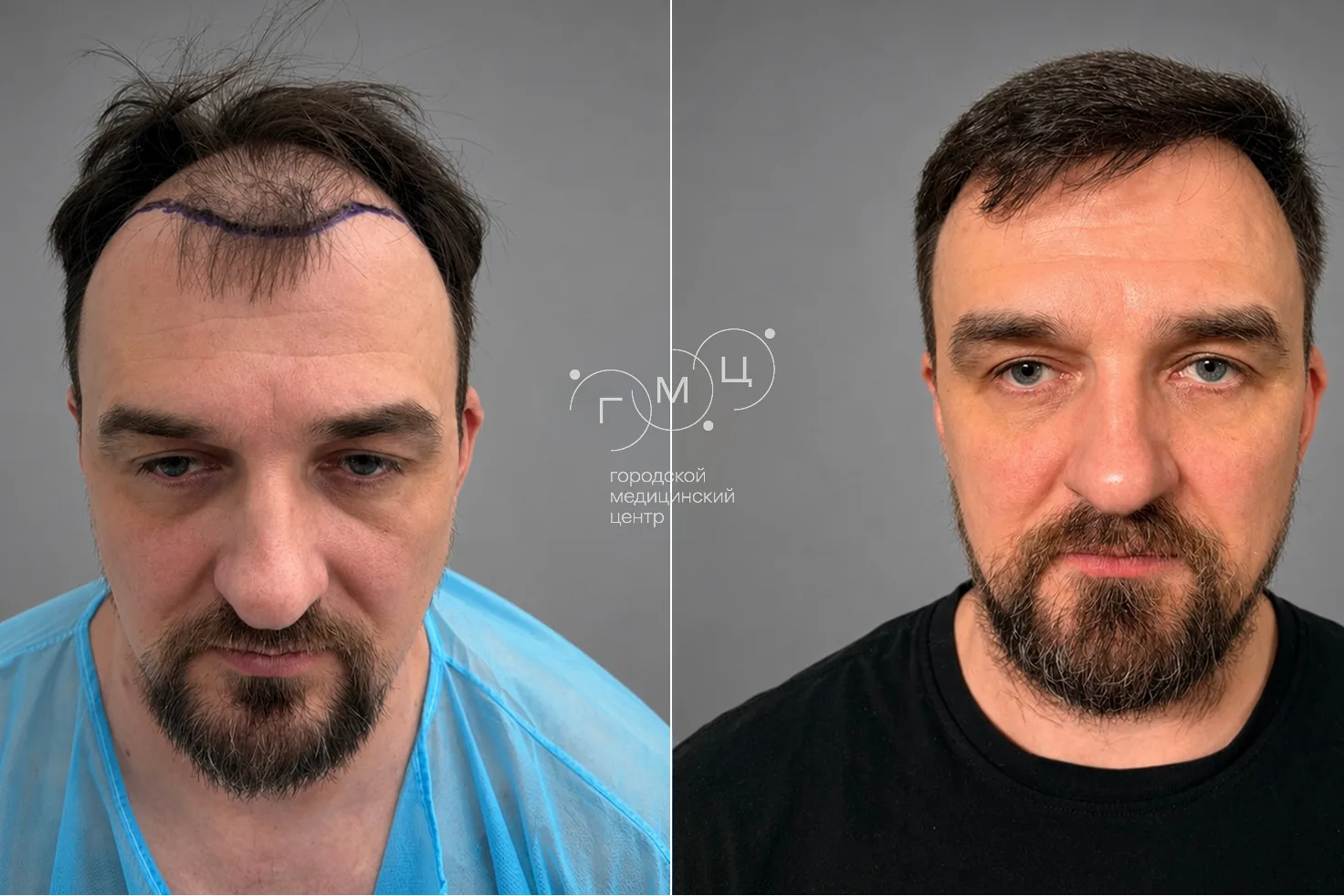 Scalp hair transplant: photo before and 12 months later, 2700 grafts, FUE method