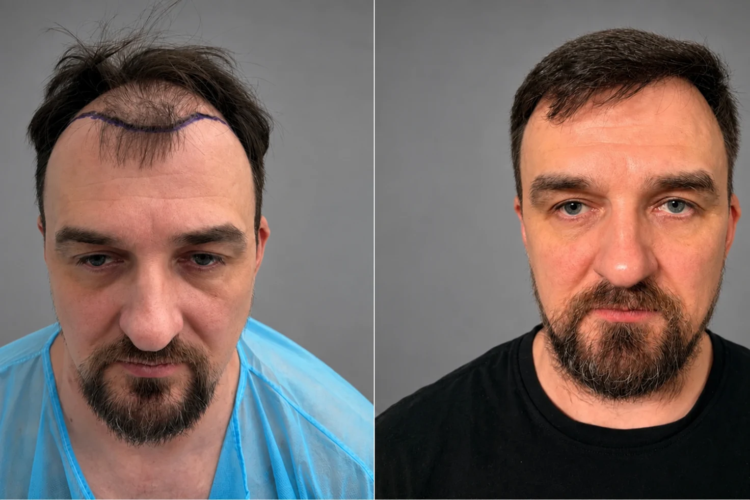 Przeszczep włosów na głowie: zdjęcie przed i 12 miesięcy później, 2700 graftów, metoda FUE