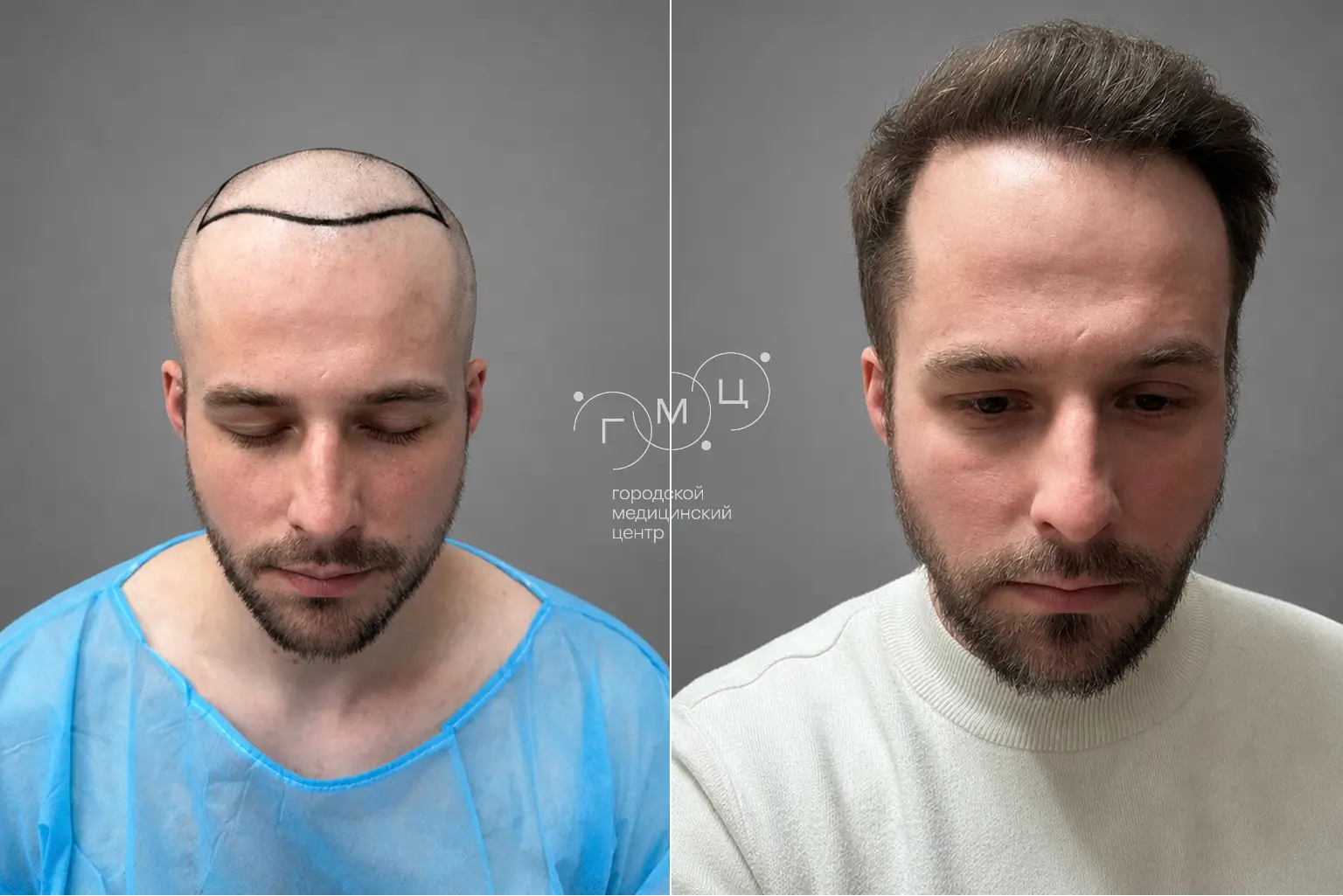 Scalp hair transplant: photo before and 12 months later, 3700 grafts, FUE method