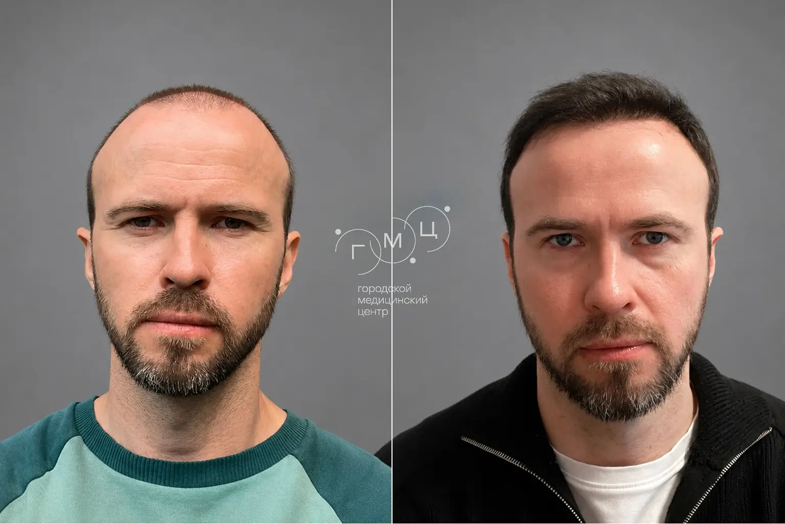 Scalp hair transplant: photo before and 12 months later, 3200 grafts, FUE method