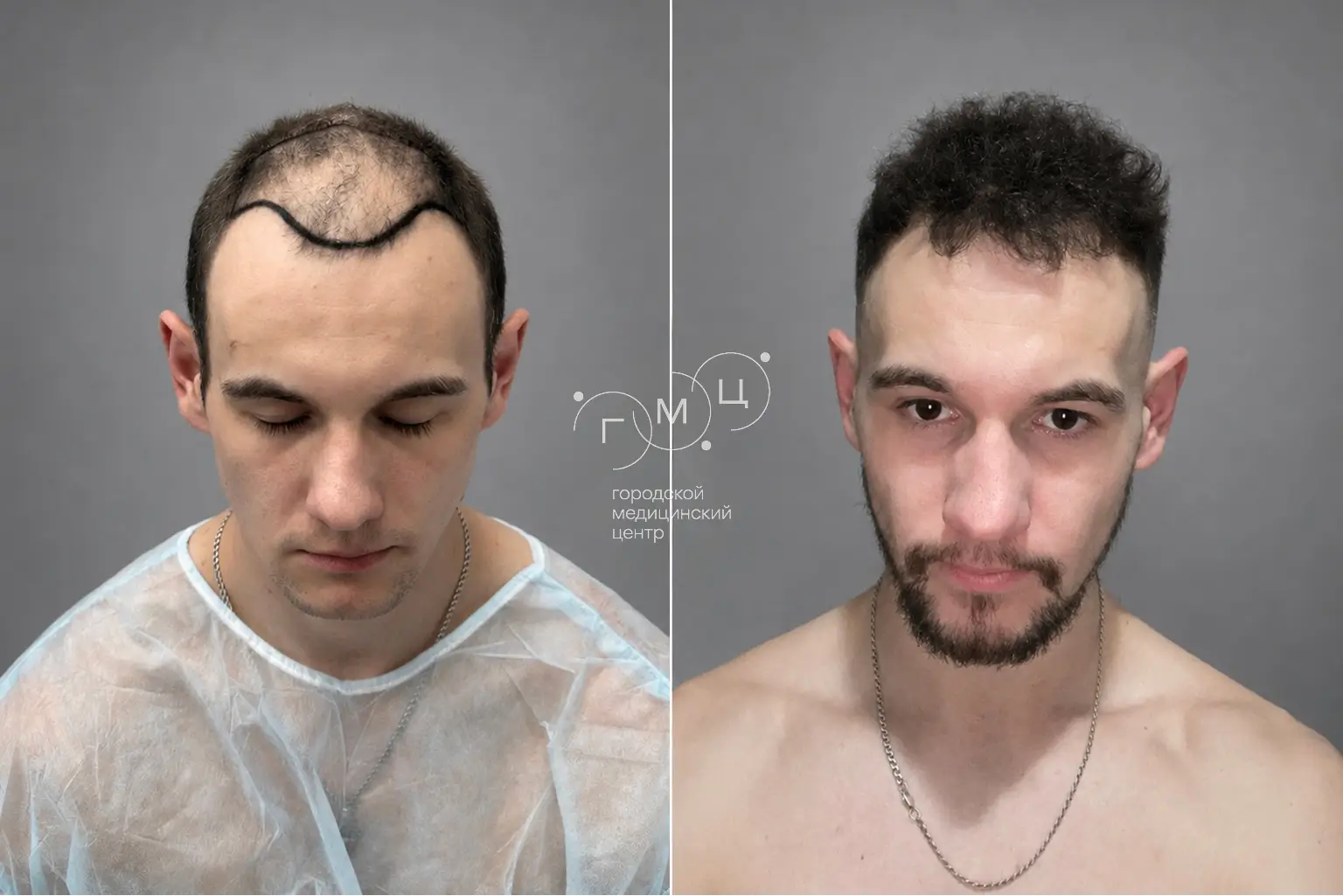 Scalp hair transplant: photo before and 12 months later, 3000 grafts, FUE method