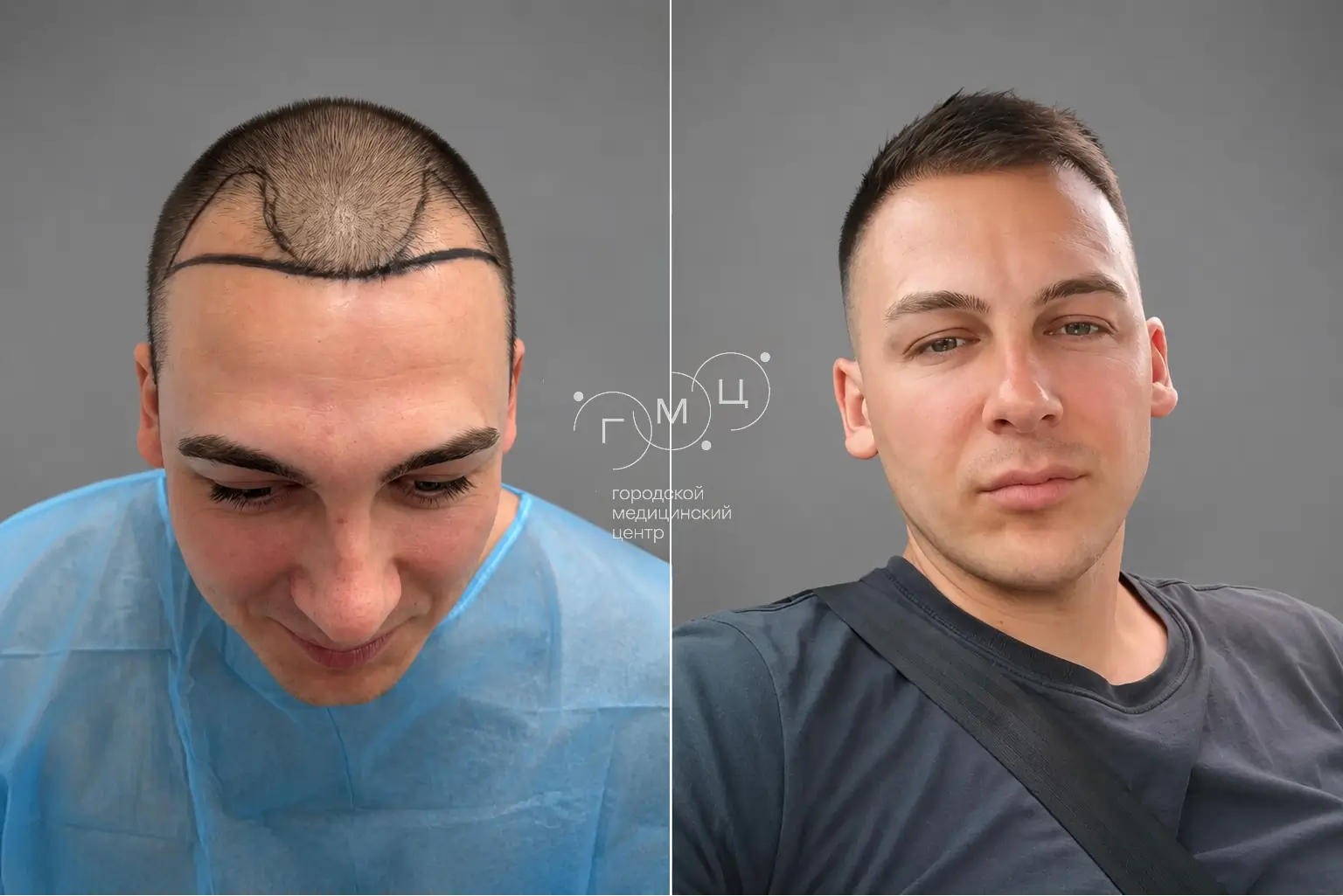 Scalp hair transplant: photo before and 12 months later, 2800 grafts, FUE method