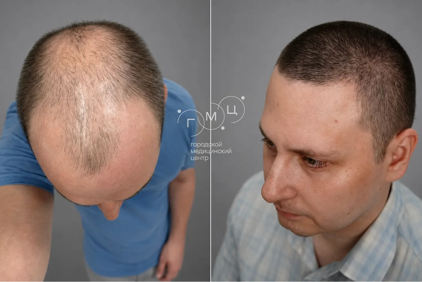 Scalp hair transplant: photo before and 12 months later, 4000 grafts, FUE method