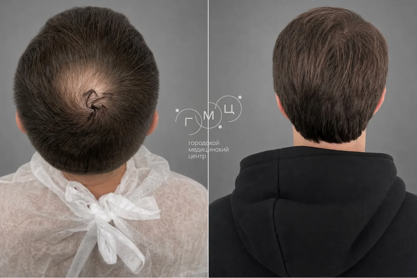 Scalp hair transplant: photo before and 12 months later, 3400 grafts, FUE method