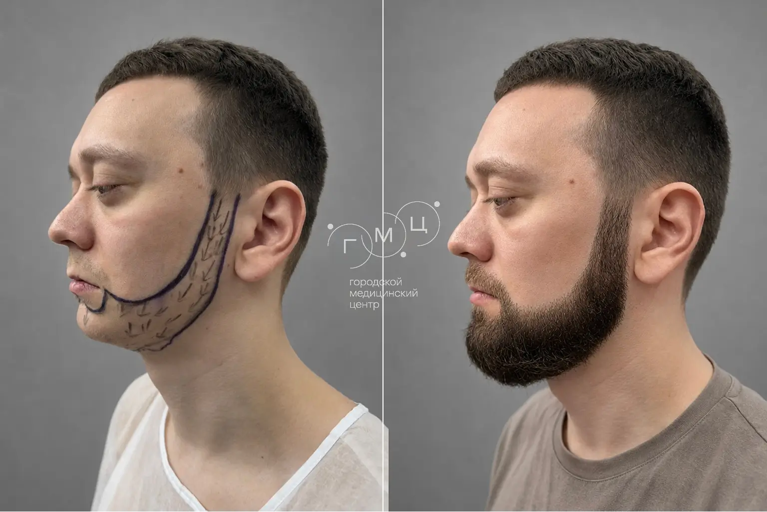 Beard transplant: photo before and 12 months later, 2500 grafts, FUE method