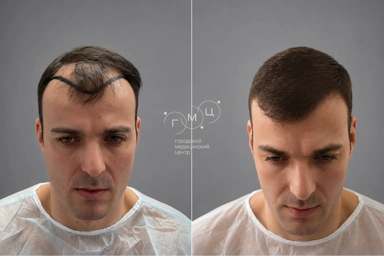 Scalp hair transplant: photo before and 12 months later, 2900 grafts, FUE method