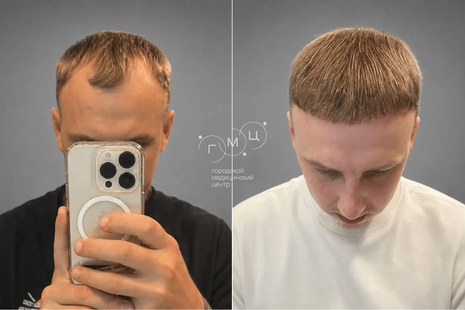 Scalp hair transplant: photo before and 12 months later, 3100 grafts, FUE method