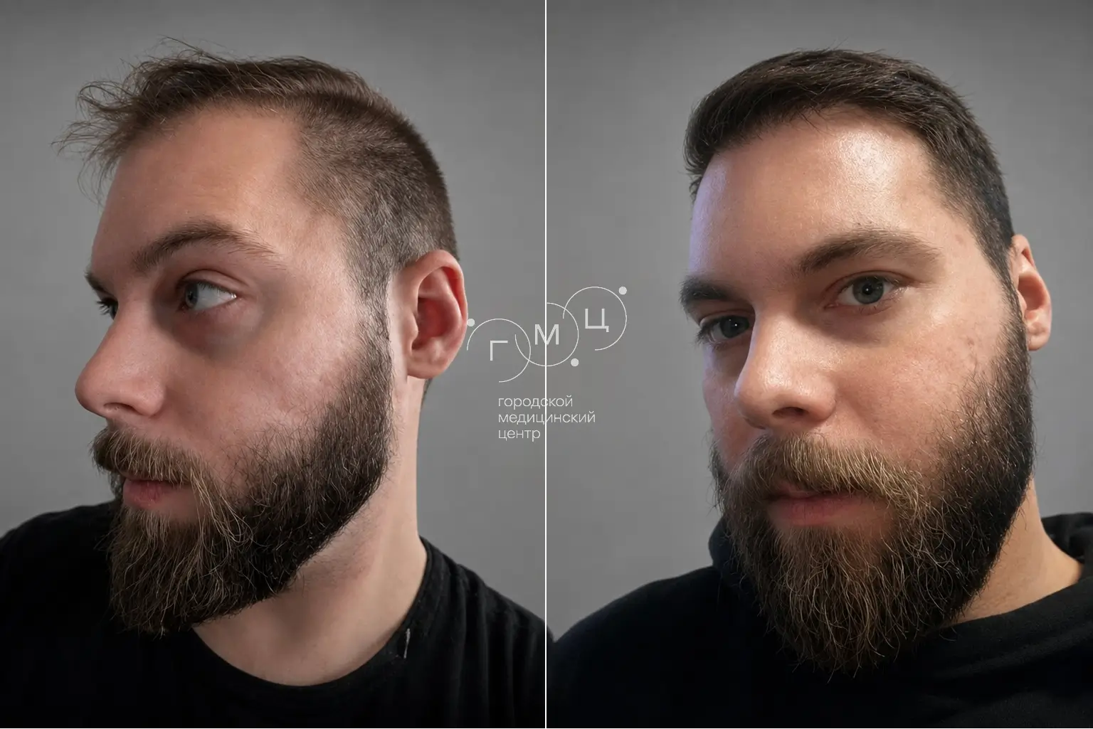 Scalp hair transplant: photo before and 12 months later, 2600 grafts, FUE method