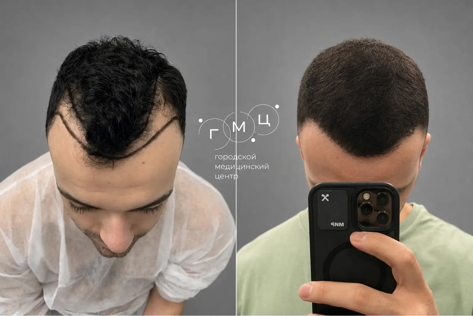Scalp hair transplant: photo before and 12 months later, 3300 grafts, FUE method