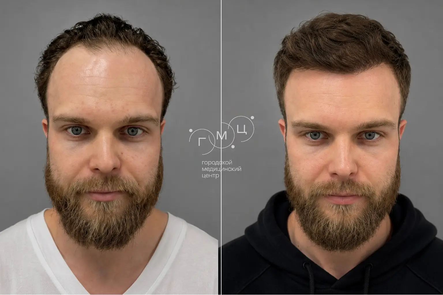 Scalp hair transplant: photo before and 12 months later, 3000 grafts, FUE method