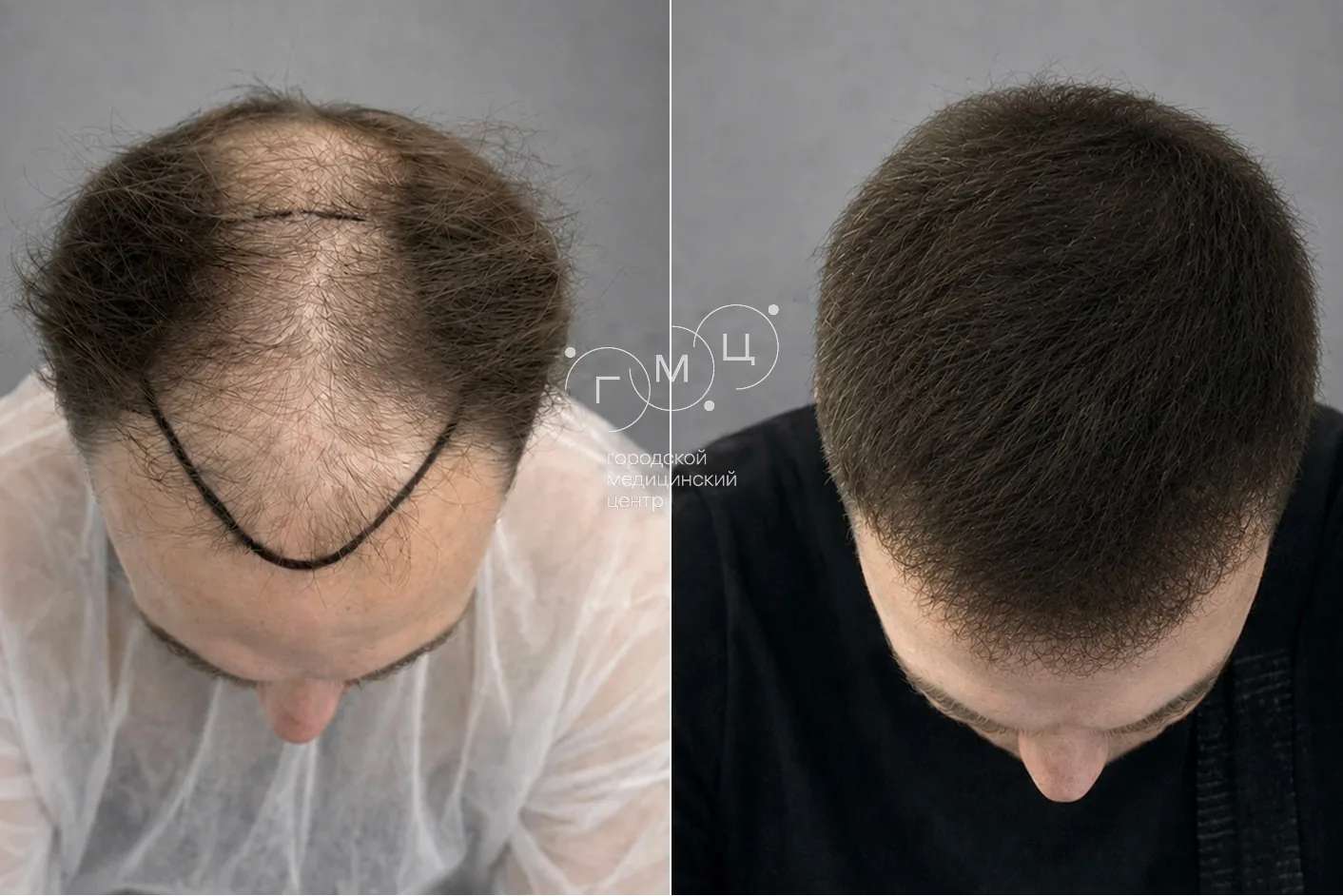 Scalp hair transplant: photo before and 12 months later, 3900 grafts, FUE method