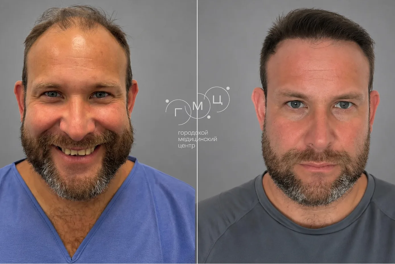 Scalp hair transplant: photo before and 12 months later, 3500 grafts, FUE method