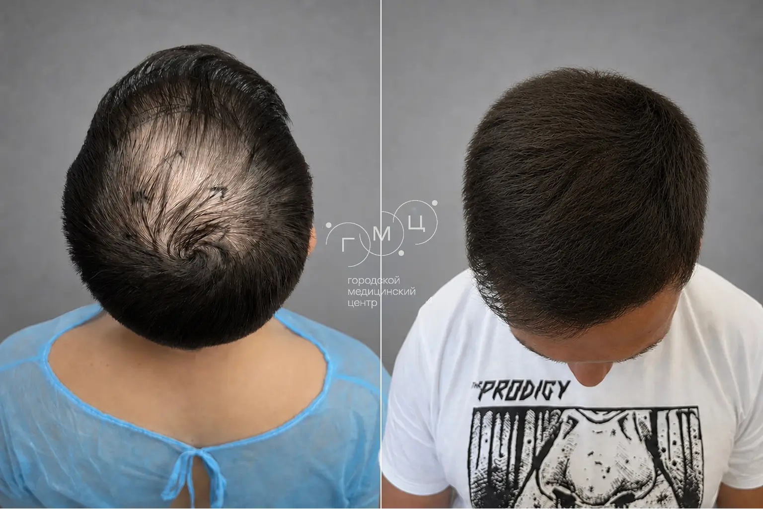 Scalp hair transplant: photo before and 12 months later, 3500 grafts, FUE method