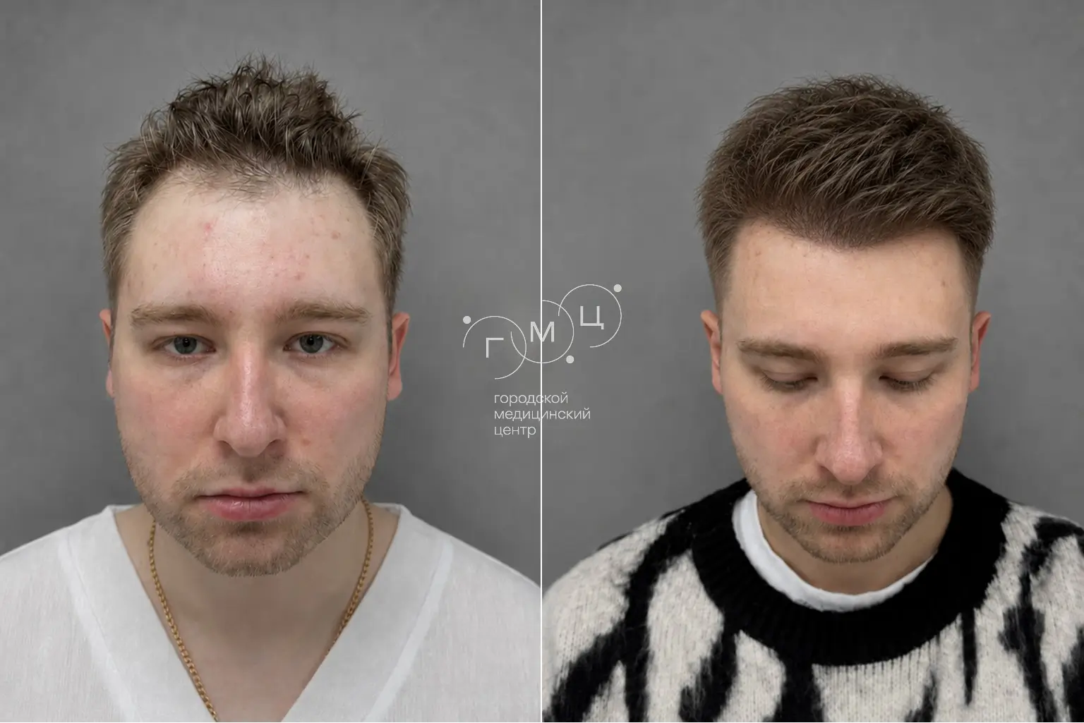Scalp hair transplant: photo before and 12 months later, 2700 grafts, FUE method