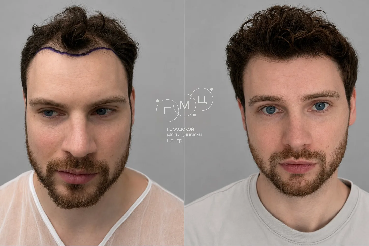 Scalp hair transplant: photo before and 12 months later, 2800 grafts, FUE method