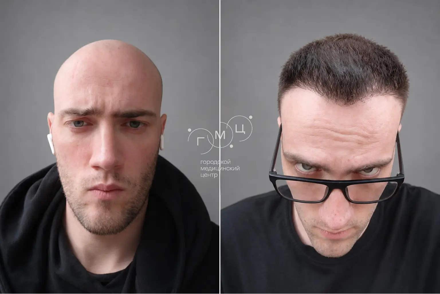 Scalp hair transplant: photo before and 12 months later, 3800 grafts, FUE method