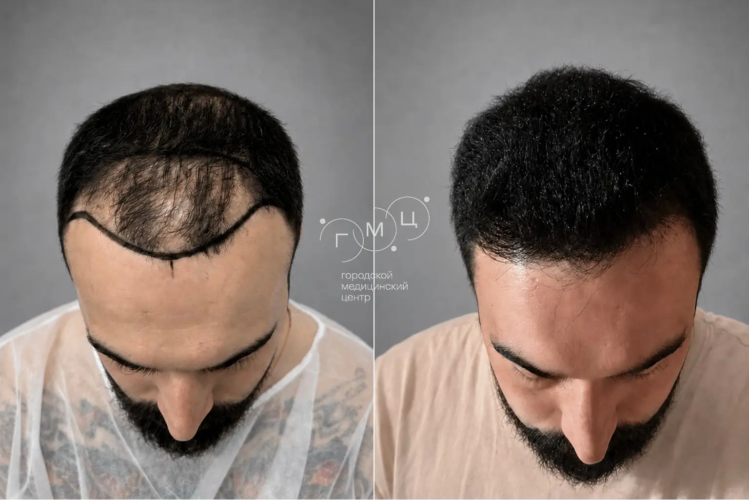 Scalp hair transplant: photo before and 12 months later, 3200 grafts, FUE method