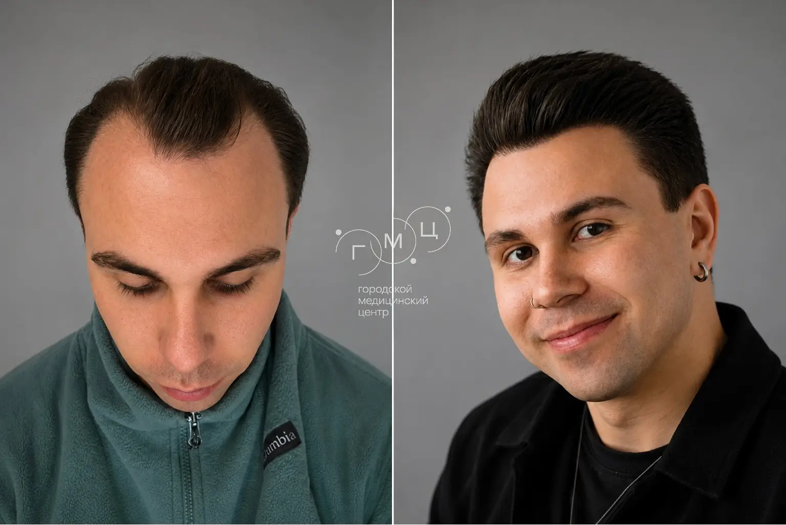 Scalp hair transplant: photo before and 12 months later, 3000 grafts, FUE method