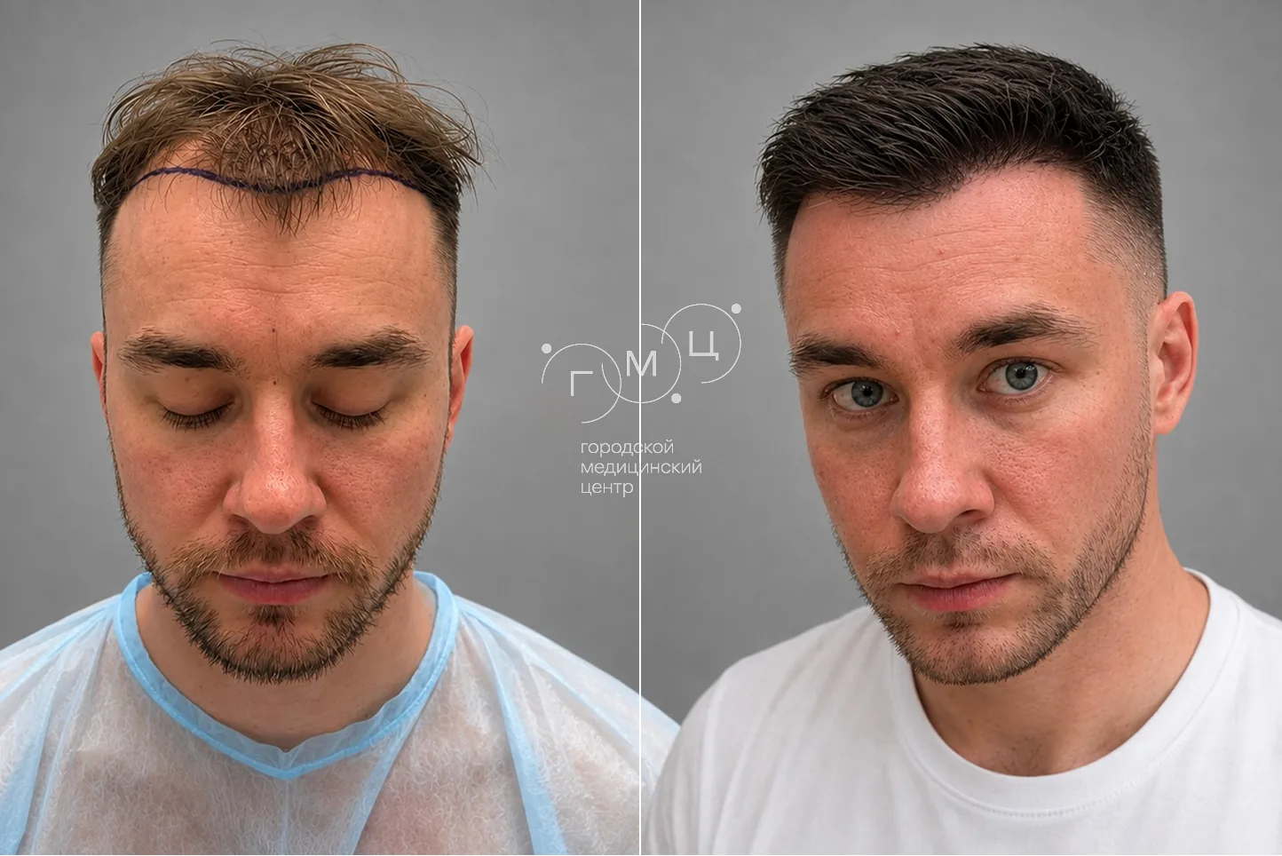 Scalp hair transplant: photo before and 12 months later, 2800 grafts, FUE method