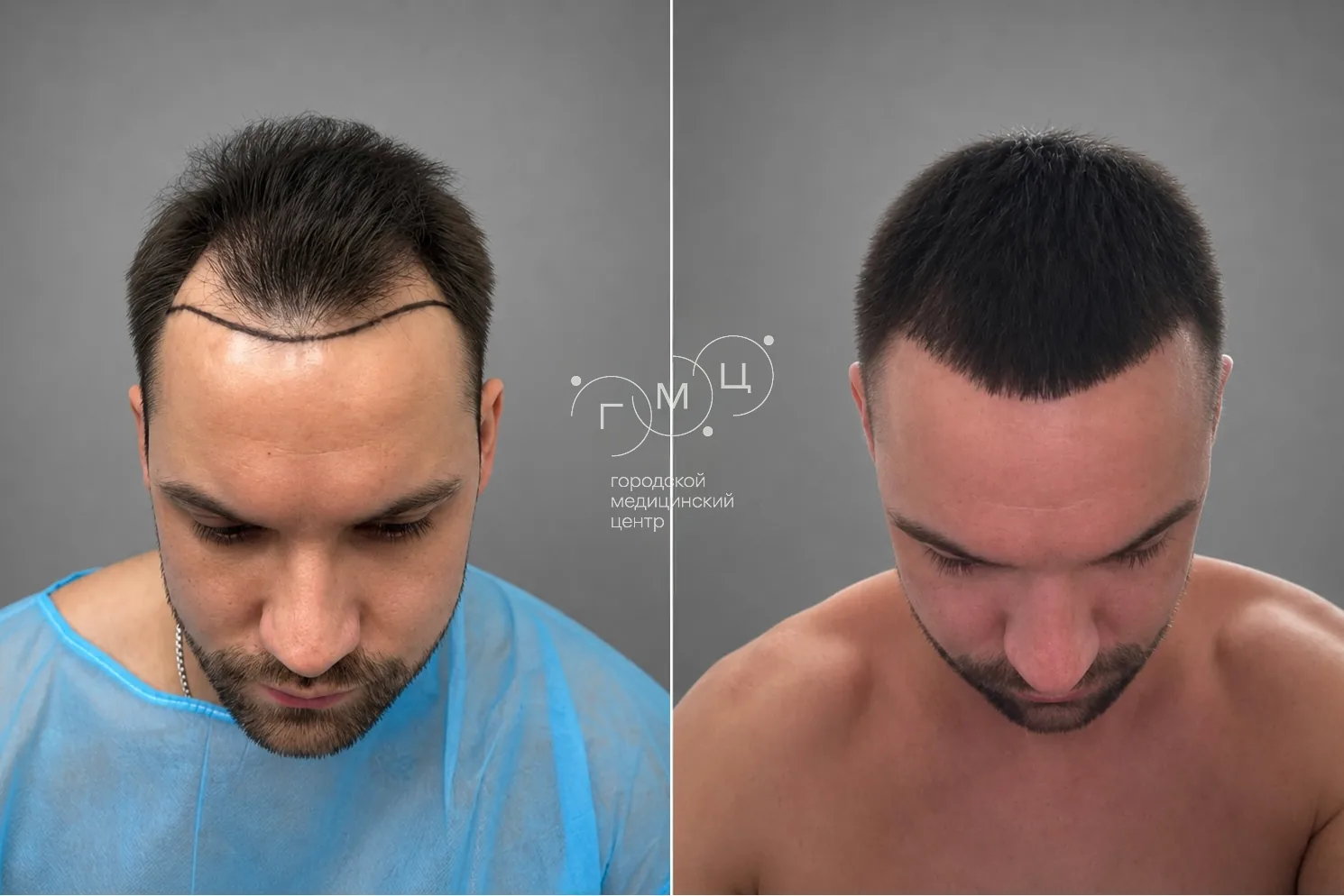 Scalp hair transplant: photo before and 12 months later, 3100 grafts, FUE method