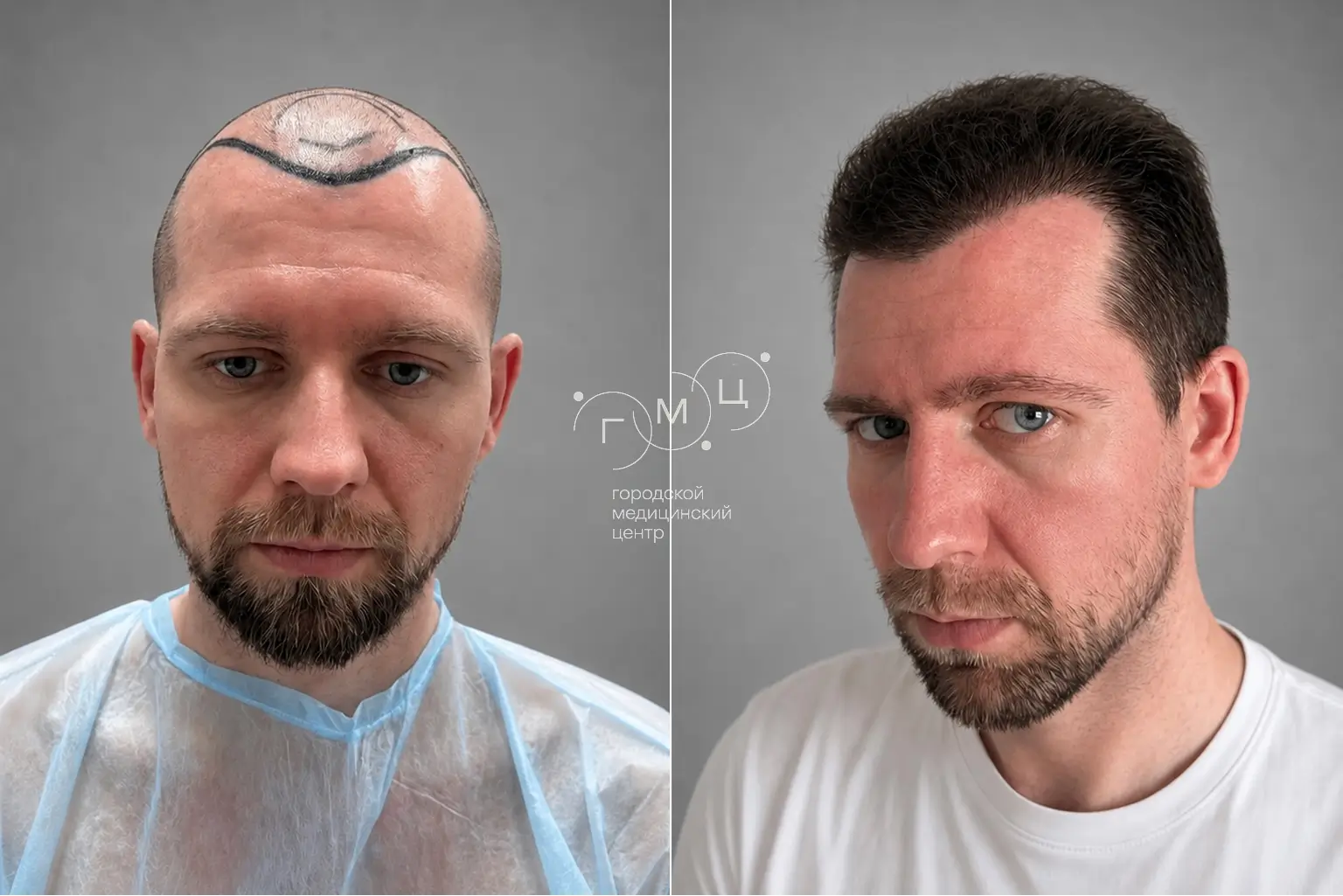 Scalp hair transplant: photo before and 12 months later, 3600 grafts, FUE method